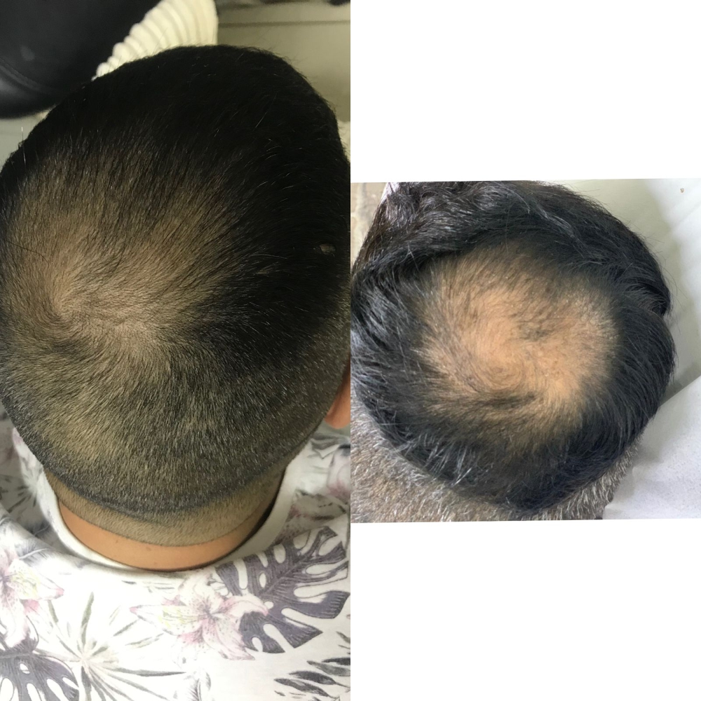 Tratamento para Queda de Cabelo e Alopecia – Dra. Cris de Paula - Imagem 3