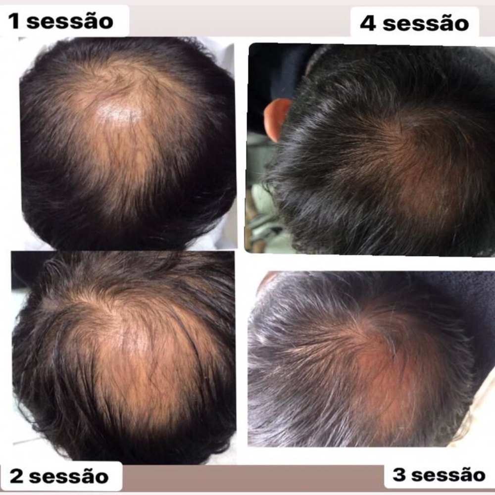 Tratamento para Queda de Cabelo e Alopecia – Dra. Cris de Paula - Imagem 4
