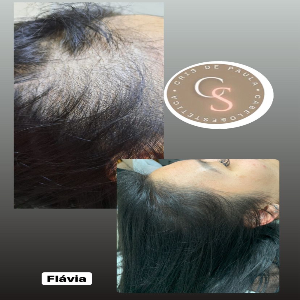 Tratamento para Queda de Cabelo e Alopecia – Dra. Cris de Paula - Imagem 5