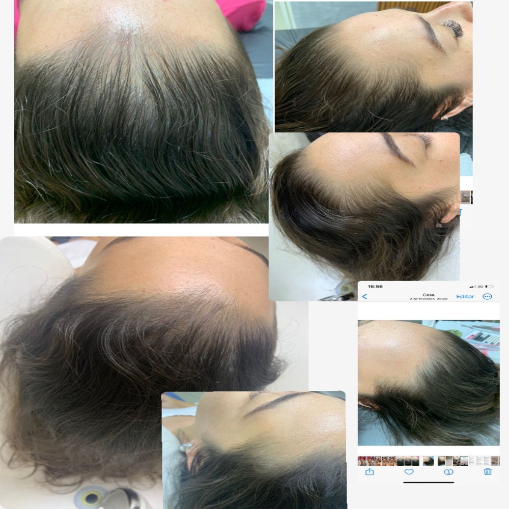 Tratamento para Queda de Cabelo e Alopecia – Dra. Cris de Paula - Imagem 6