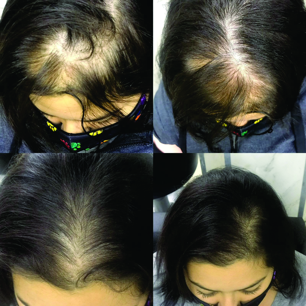 Tratamento para Queda de Cabelo e Alopecia – Dra. Cris de Paula - Imagem 8
