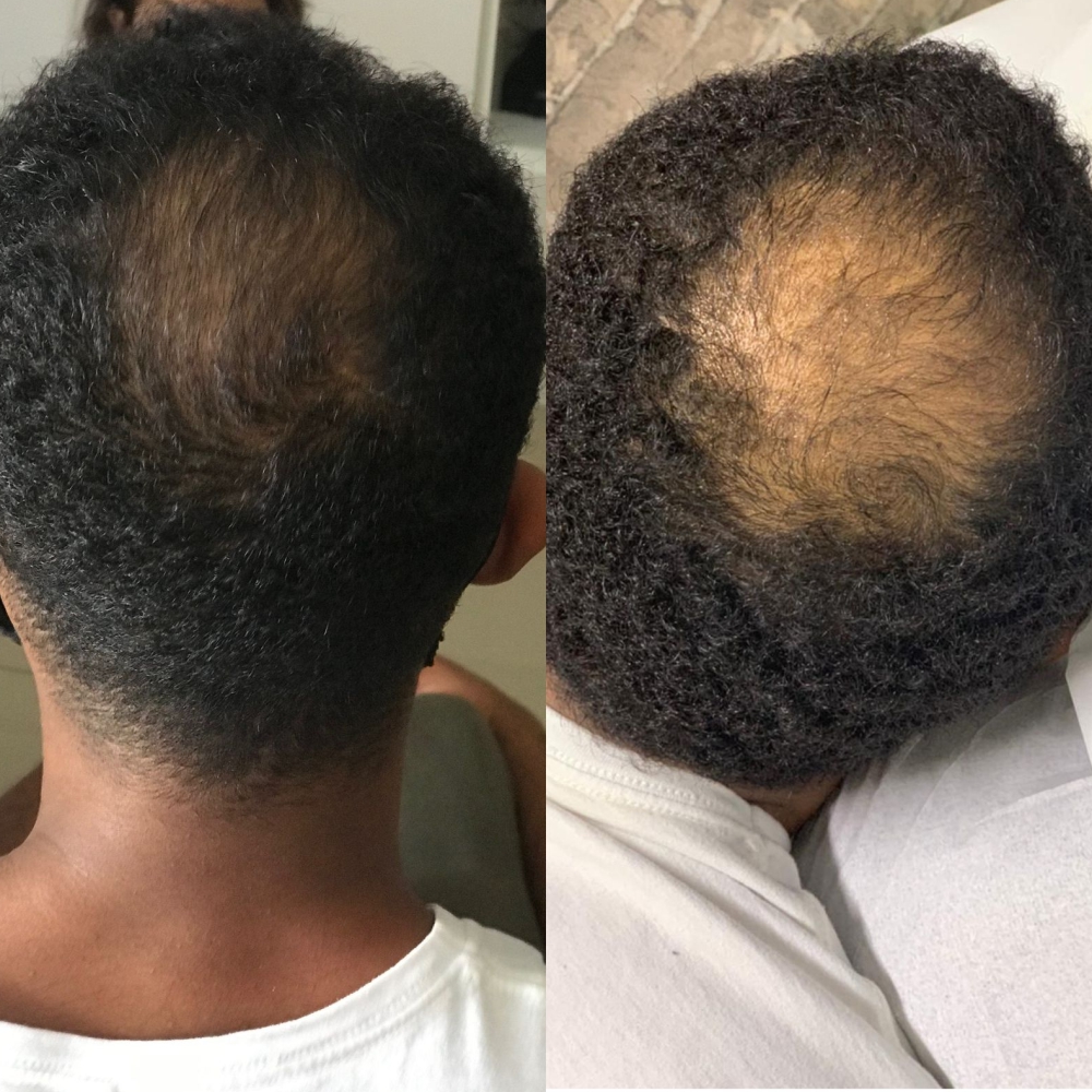 Tratamento para Queda de Cabelo e Alopecia – Dra. Cris de Paula - Imagem 9